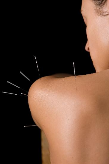Acupuncture in Chester